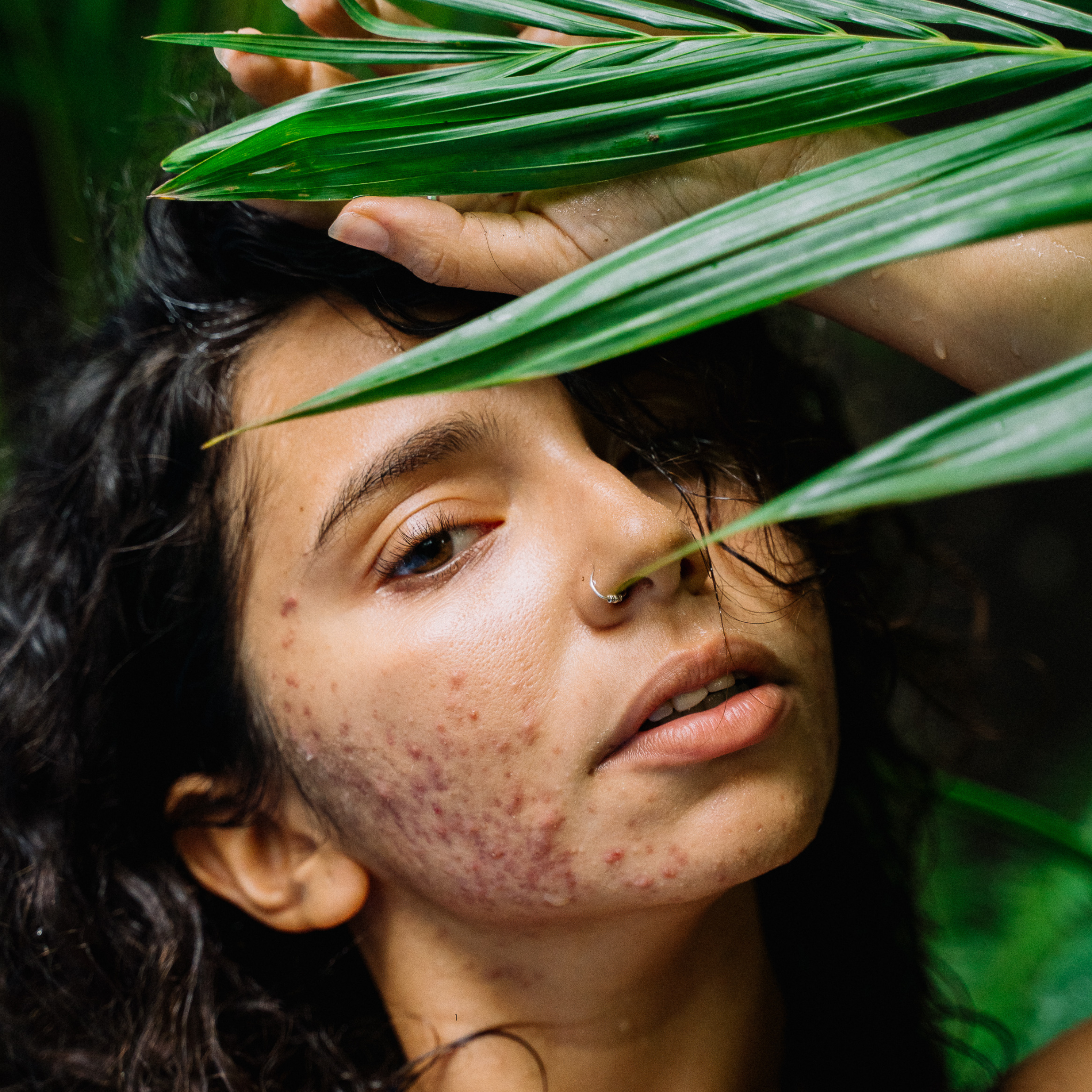 Let’s Learn About Acne!